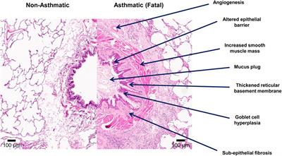 Airway remodeling heterogeneity in asthma and its relationship to disease outcomes